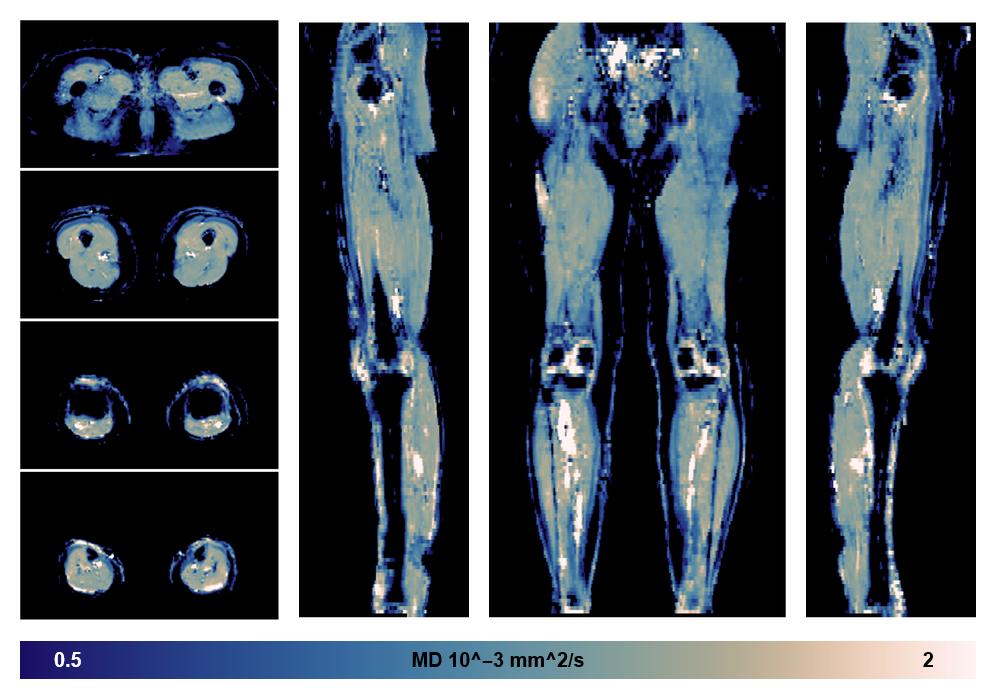 IVIM corrected whole leg muscle mean diffusivity obtained from diffusion tensor imaging.