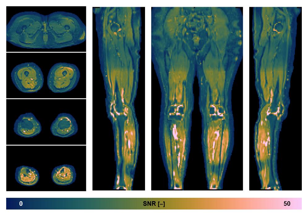 SNR distribution of the unweighted diffusion data.
