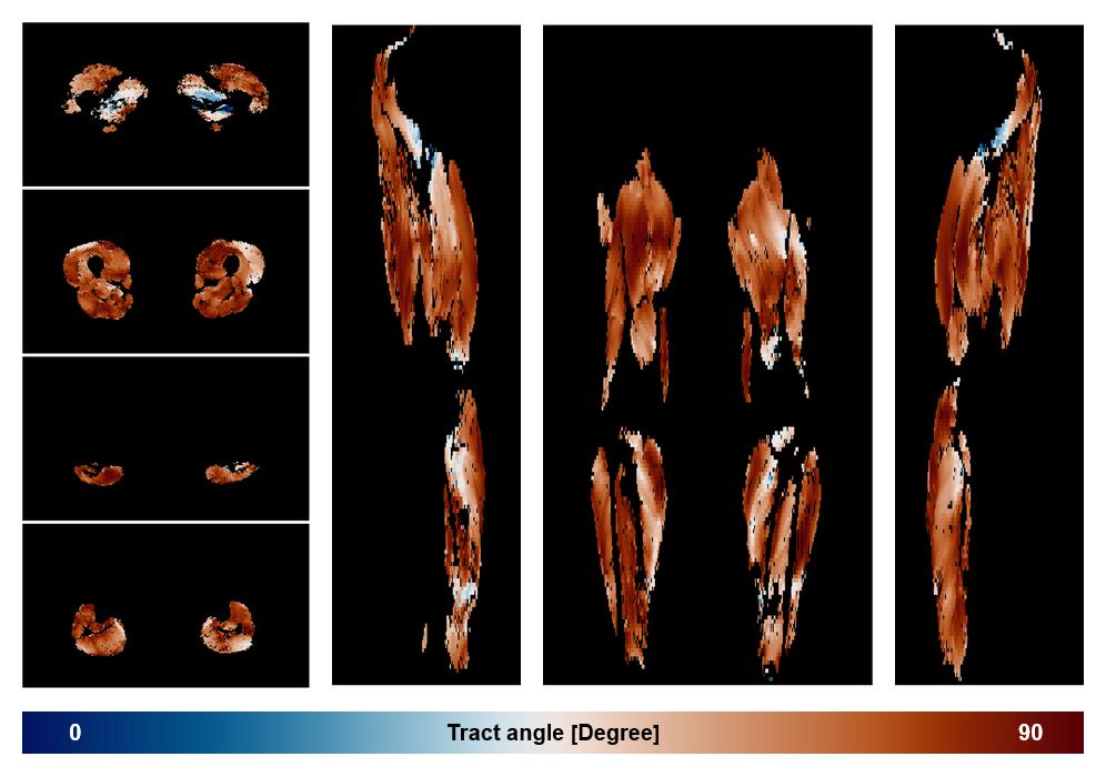 Muscle fiber tract angle map based on whole leg DTI based fiber tractography.