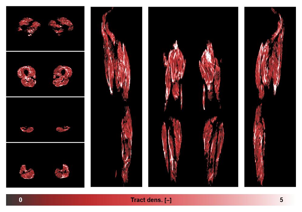 Muscle fiber tract density map based on whole leg DTI based fiber tractography.