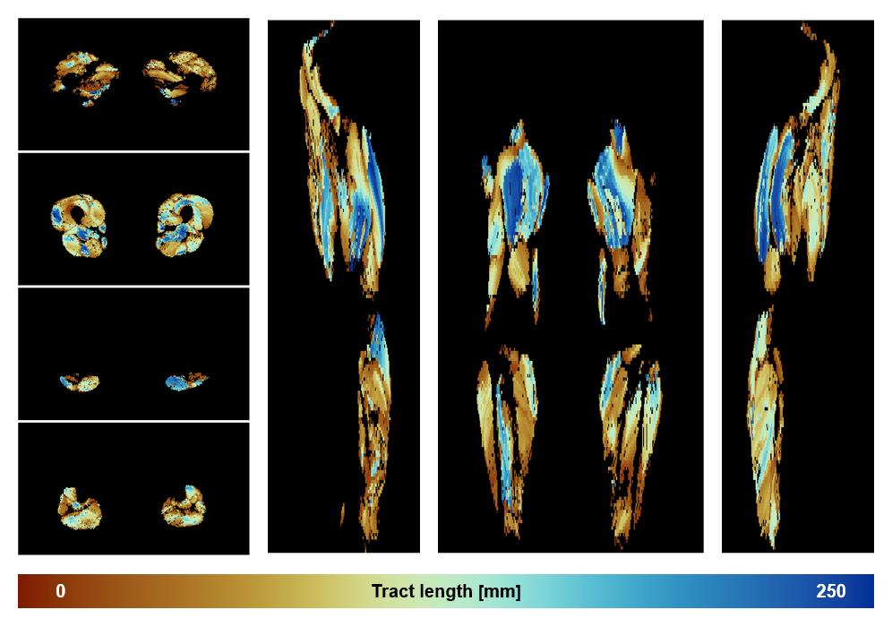 Muscle fiber tract length map based on whole leg DTI based fiber tractography.