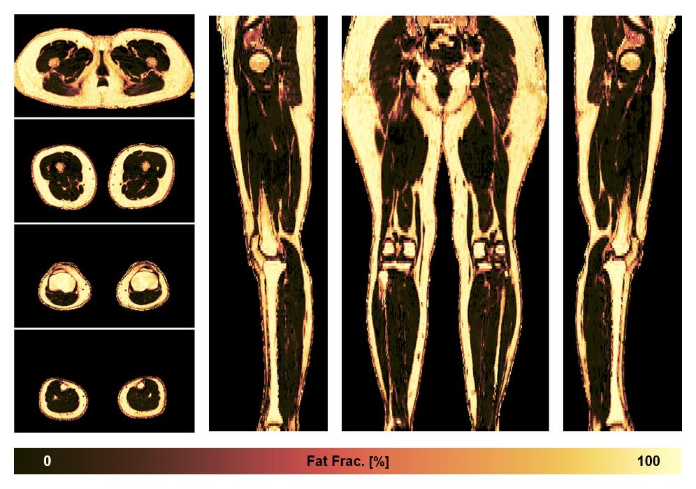 The fat fraction of the lower extremity obtained from the dixon reconstruction for muscle water fat quantification.
