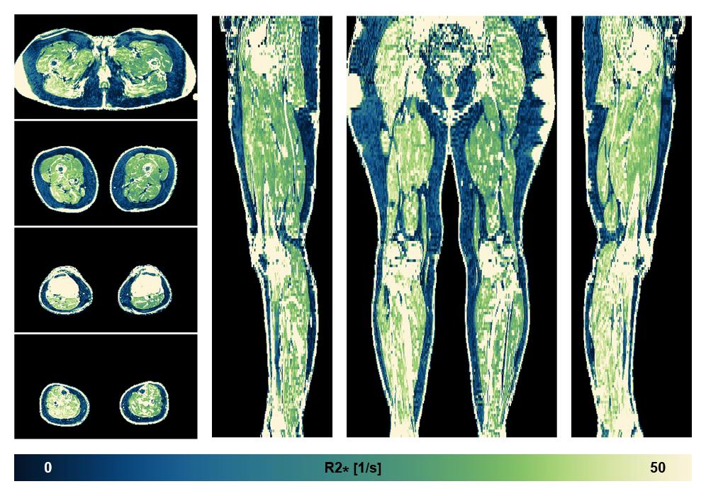 The R2 star relaxation time of the lower extremity obtained from the dixon reconstruction for muscle water fat quantification.