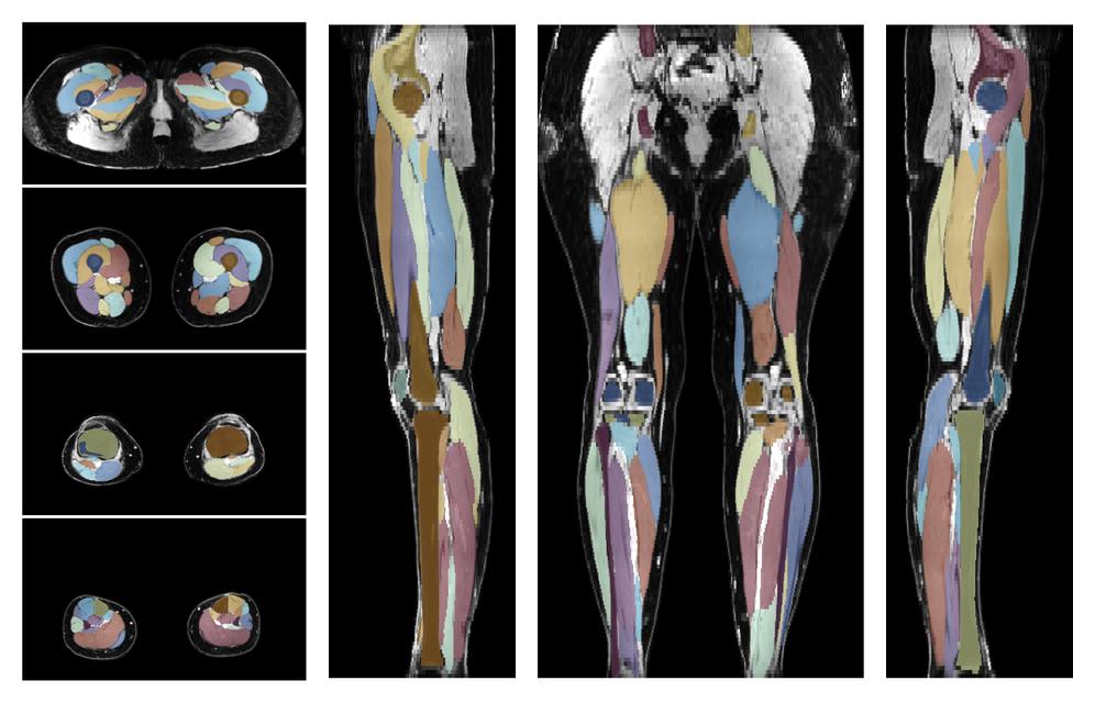Overlay of automated muscle segmentation labels on dixon water image.