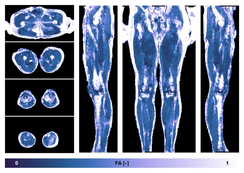 IVIM corrected whole leg muscle fractional anisotropy obtained from diffusion tensor imaging.