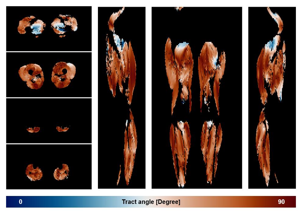 Muscle fiber tract angle map based on whole leg DTI based fiber tractography.