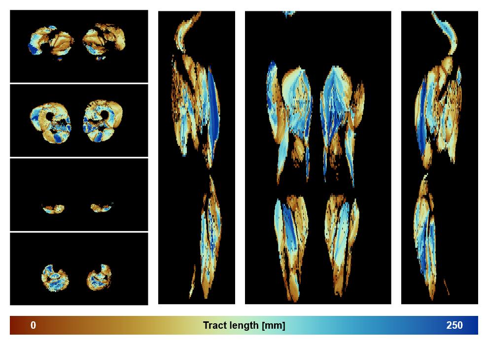 Muscle fiber tract length map based on whole leg DTI based fiber tractography.