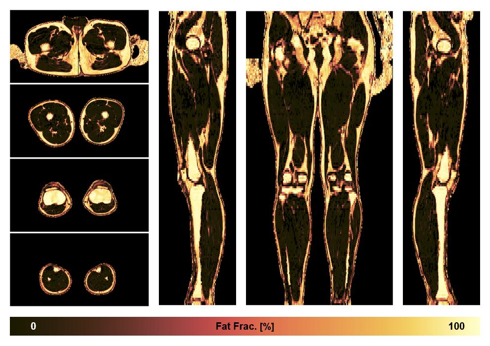 The fat fraction of the lower extremity obtained from the dixon reconstruction for muscle water fat quantification.