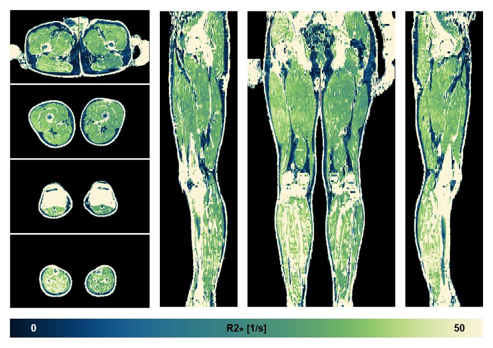 The R2 star relaxation time of the lower extremity obtained from the dixon reconstruction for muscle water fat quantification.