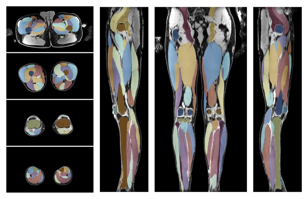 Overlay of automated muscle segmentation labels on dixon water image.