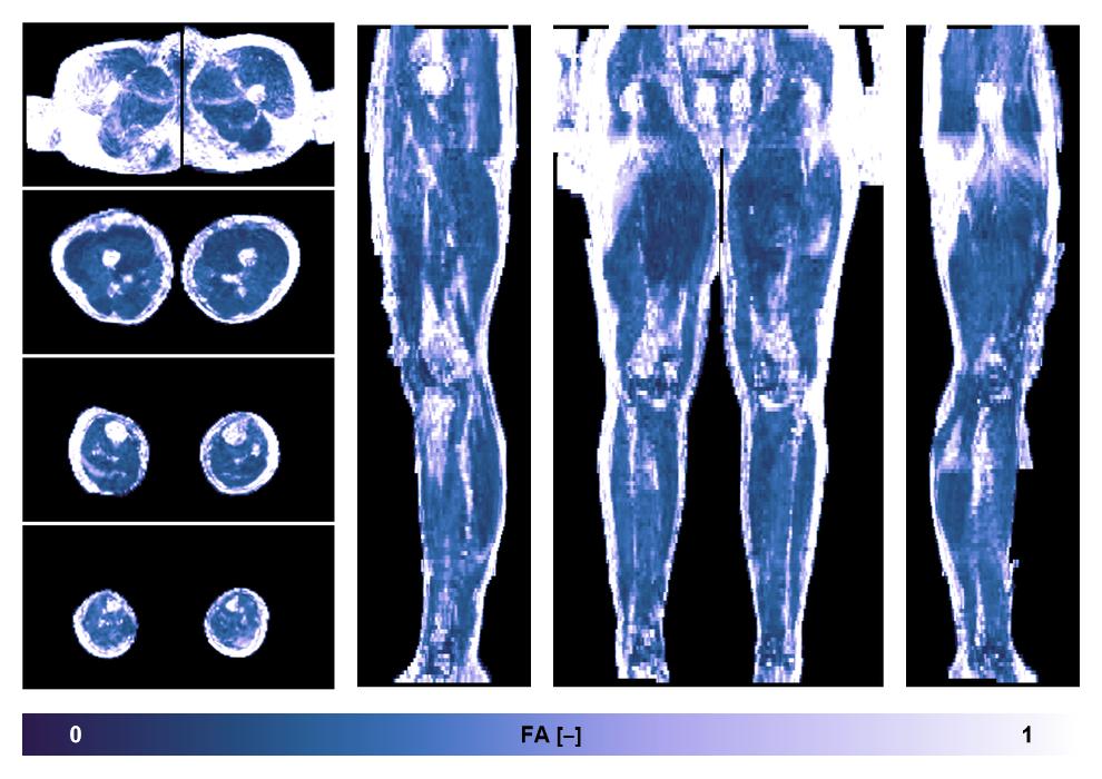 IVIM corrected whole leg muscle fractional anisotropy obtained from diffusion tensor imaging.