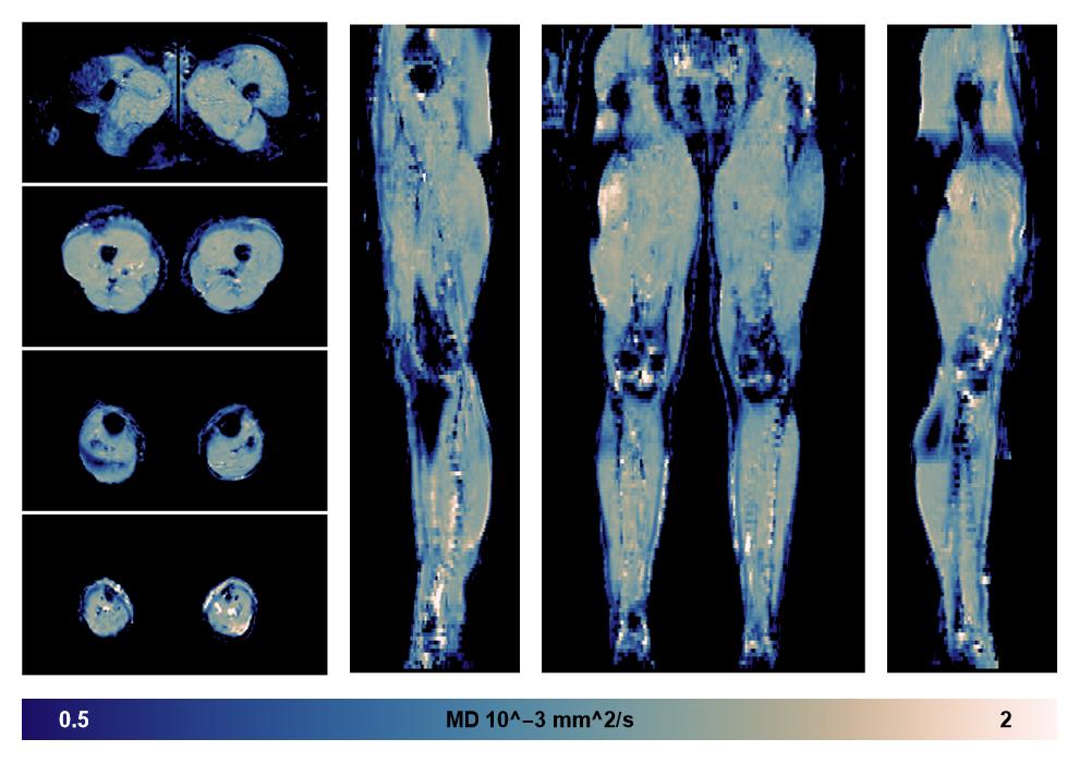 IVIM corrected whole leg muscle mean diffusivity obtained from diffusion tensor imaging.