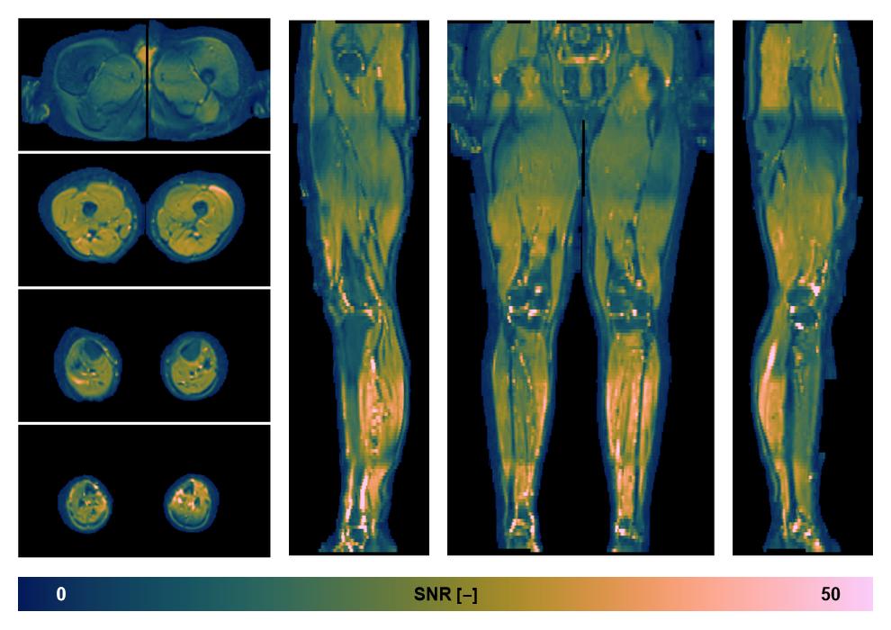 SNR distribution of the unweighted diffusion data.