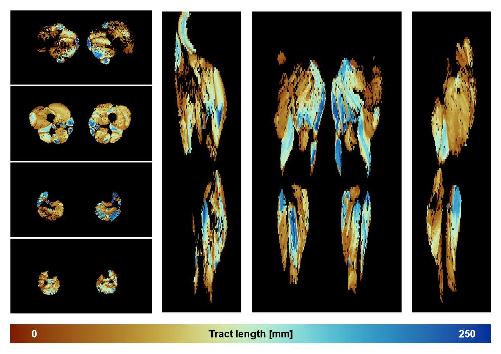 Muscle fiber tract length map based on whole leg DTI based fiber tractography.