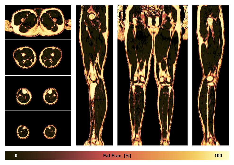 The fat fraction of the lower extremity obtained from the dixon reconstruction for muscle water fat quantification.