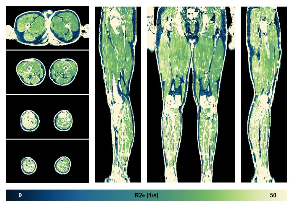 The R2 star relaxation time of the lower extremity obtained from the dixon reconstruction for muscle water fat quantification.