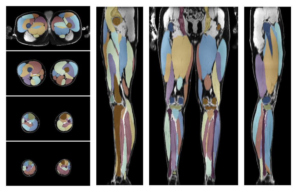 Overlay of automated muscle segmentation labels on dixon water image.