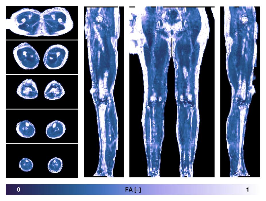 IVIM corrected whole leg muscle fractional anisotropy obtained from diffusion tensor imaging.