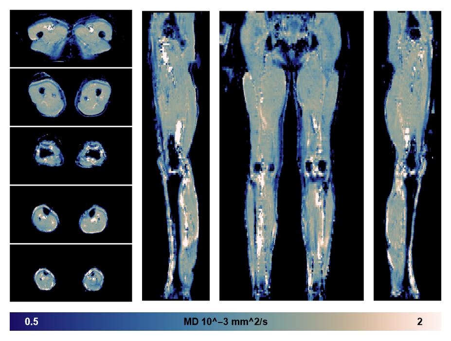 IVIM corrected whole leg muscle mean diffusivity obtained from diffusion tensor imaging.