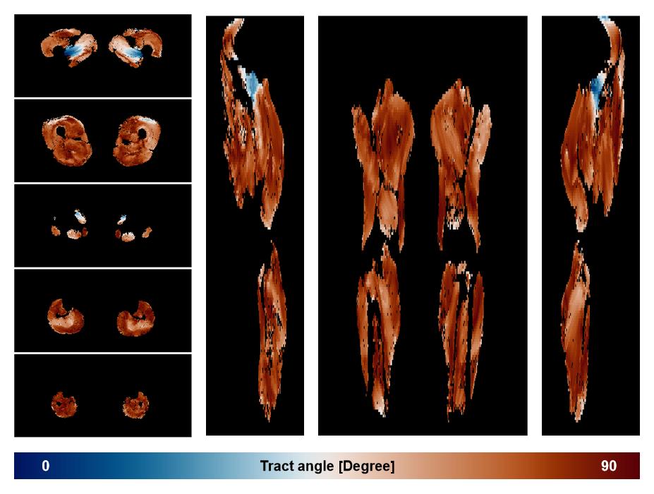 Muscle fiber tract angle map based on whole leg DTI based fiber tractography.