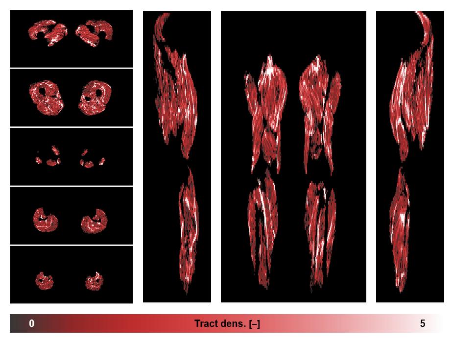 Muscle fiber tract density map based on whole leg DTI based fiber tractography.