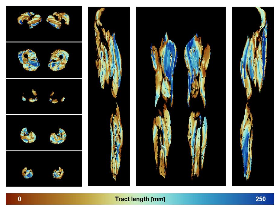 Muscle fiber tract length map based on whole leg DTI based fiber tractography.