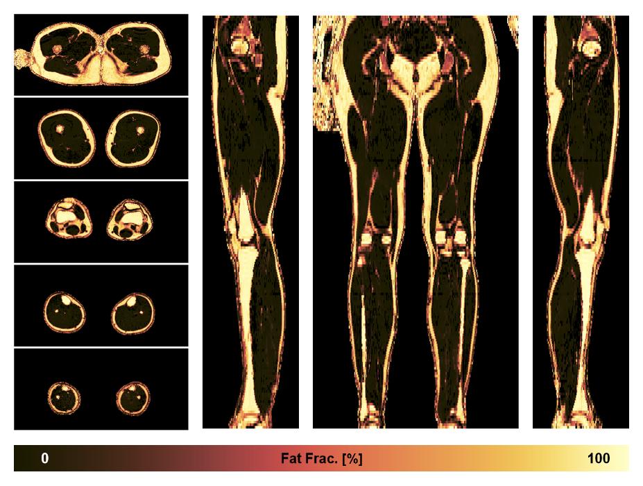 The fat fraction of the lower extremity obtained from the dixon reconstruction for muscle water fat quantification.