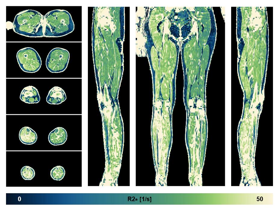 The R2 star relaxation time of the lower extremity obtained from the dixon reconstruction for muscle water fat quantification.