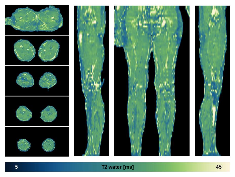 The water only T2 relaxation time of the lower extremity obtained from multi echo spin echo t2 mapping with EPG based reconstruction.