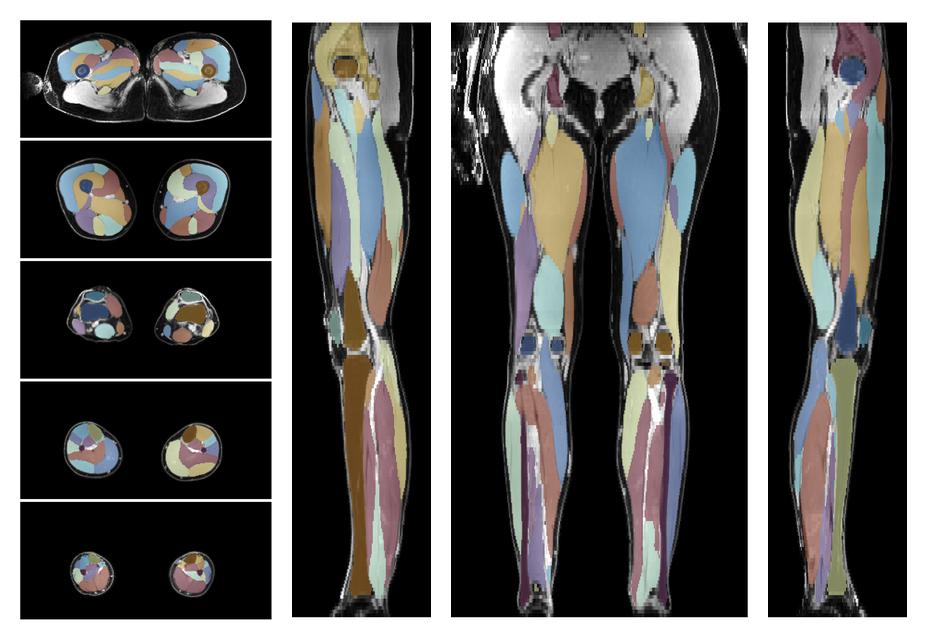 Overlay of automated muscle segmentation labels on dixon water image.