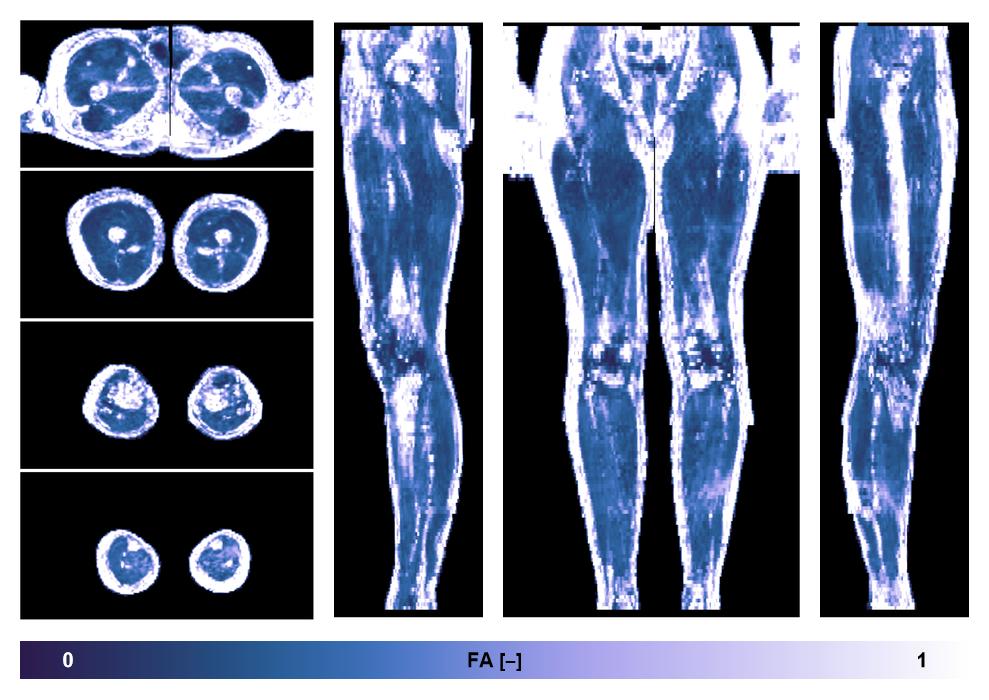 IVIM corrected whole leg muscle fractional anisotropy obtained from diffusion tensor imaging.
