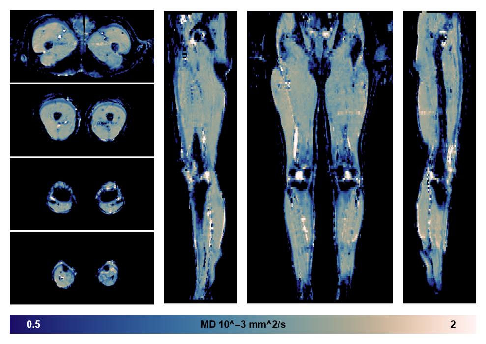 IVIM corrected whole leg muscle mean diffusivity obtained from diffusion tensor imaging.