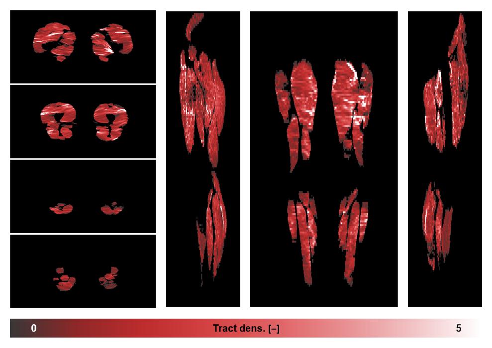 Muscle fiber tract density map based on whole leg DTI based fiber tractography.