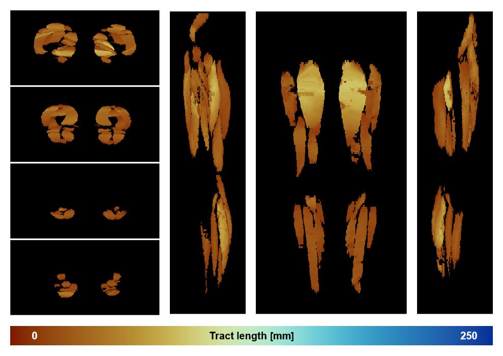 Muscle fiber tract length map based on whole leg DTI based fiber tractography.
