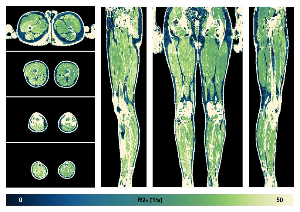The R2 star relaxation time of the lower extremity obtained from the dixon reconstruction for muscle water fat quantification.