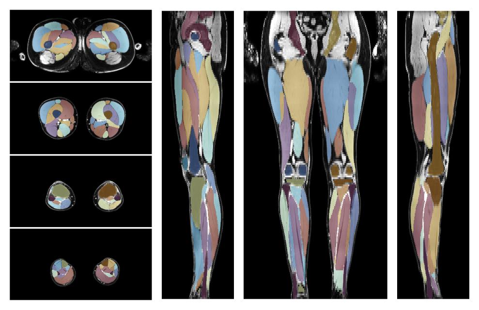Overlay of automated muscle segmentation labels on dixon water image.