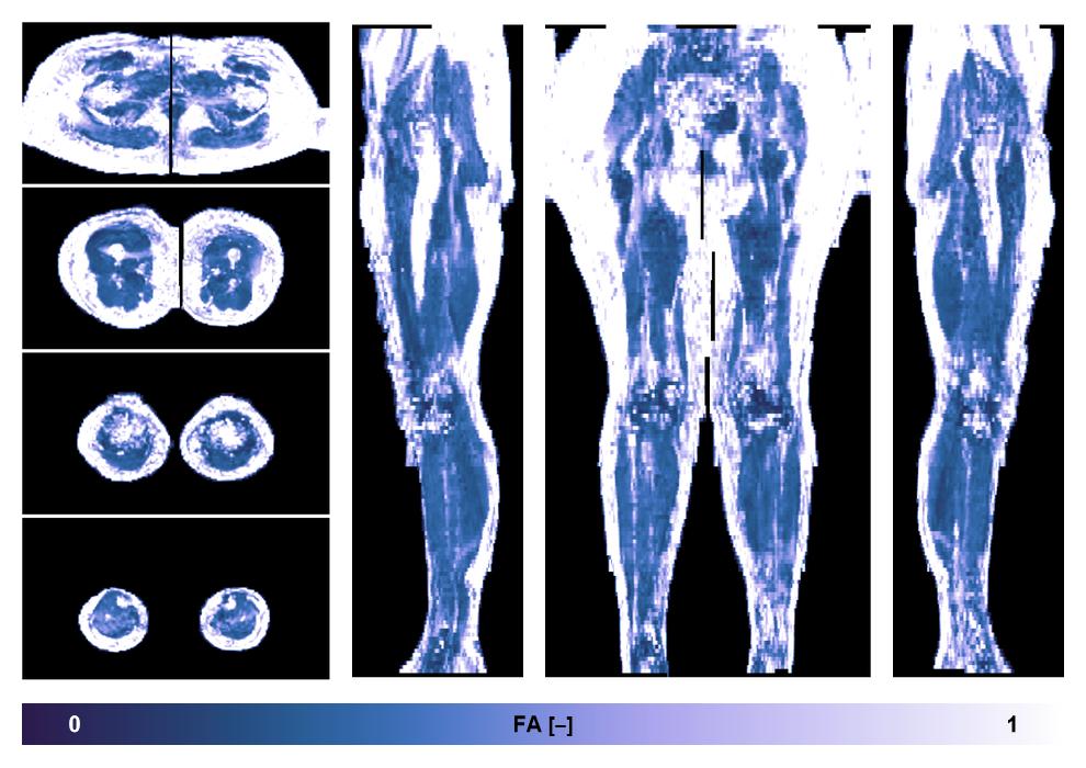 IVIM corrected whole leg muscle fractional anisotropy obtained from diffusion tensor imaging.