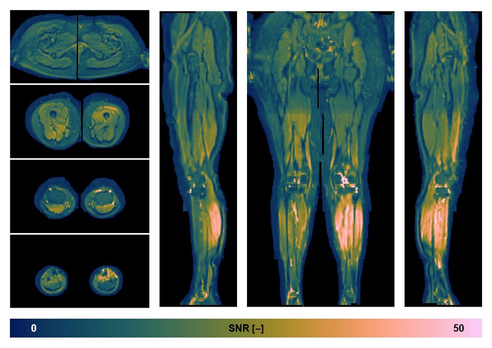 SNR distribution of the unweighted diffusion data.