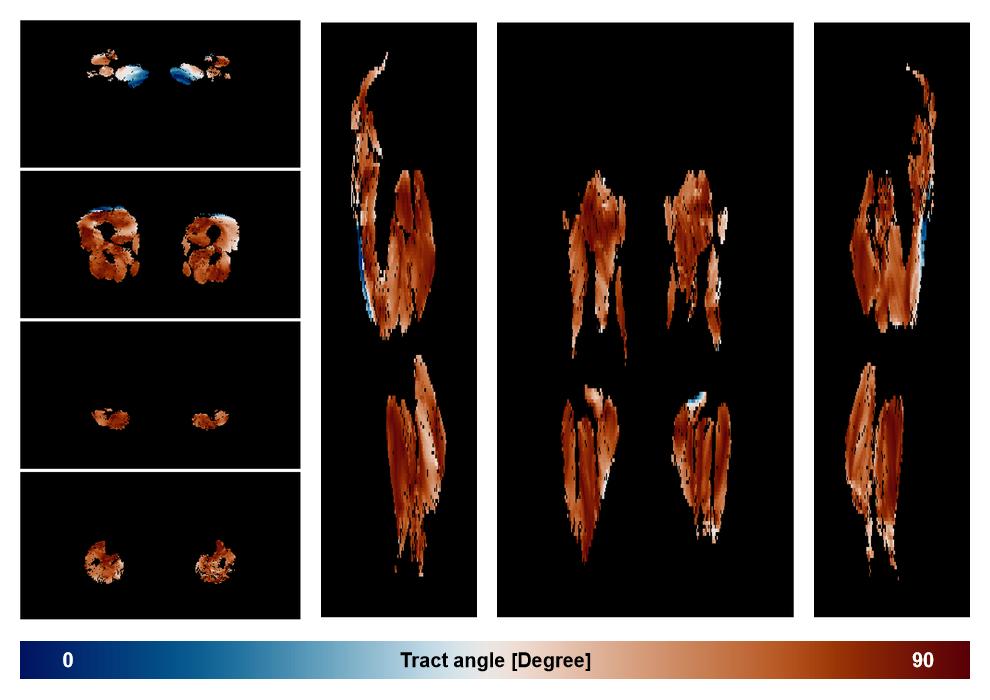 Muscle fiber tract angle map based on whole leg DTI based fiber tractography.