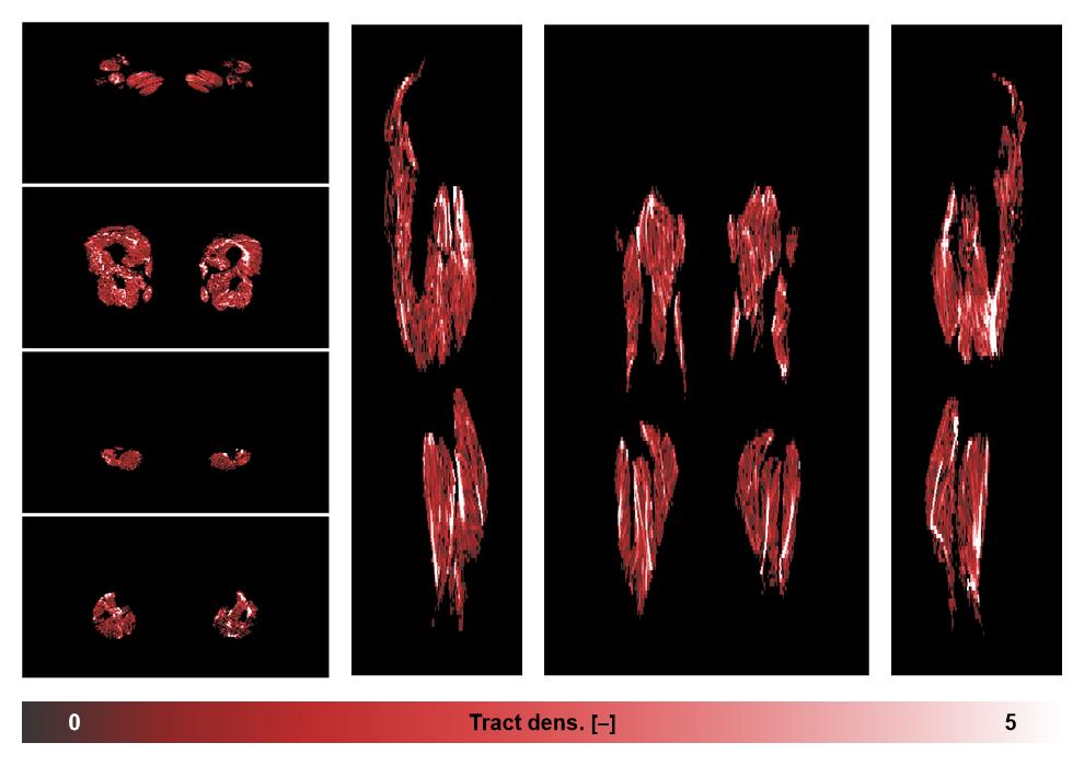 Muscle fiber tract density map based on whole leg DTI based fiber tractography.