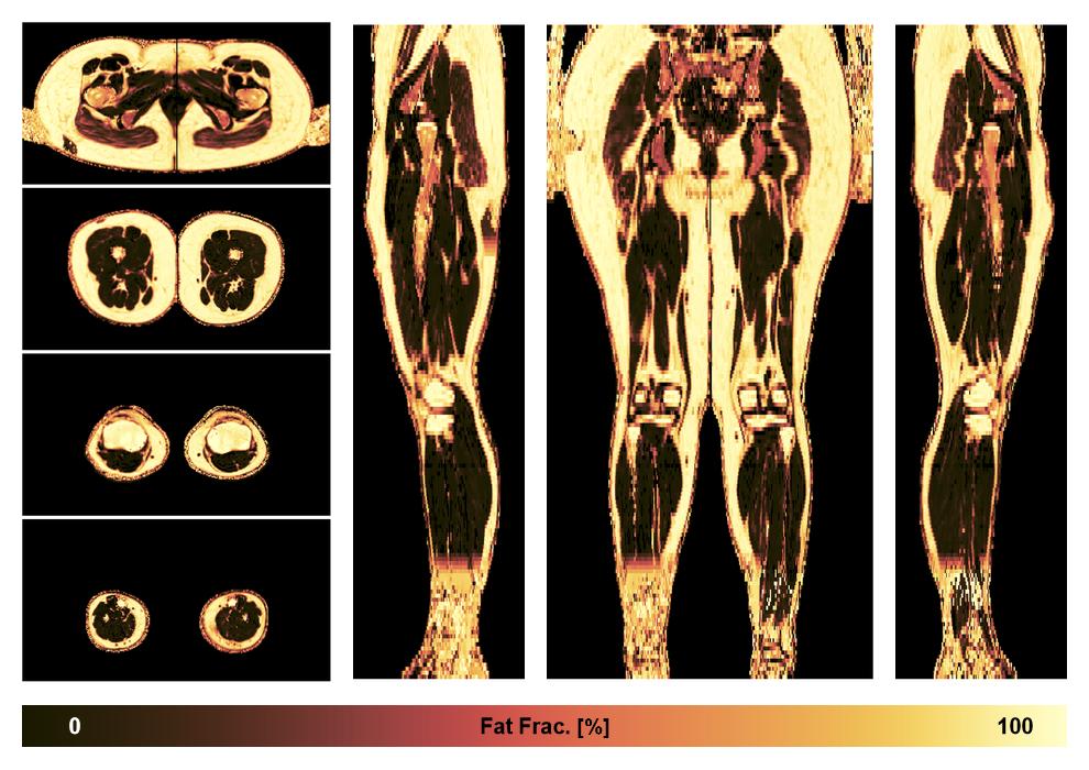 The fat fraction of the lower extremity obtained from the dixon reconstruction for muscle water fat quantification.