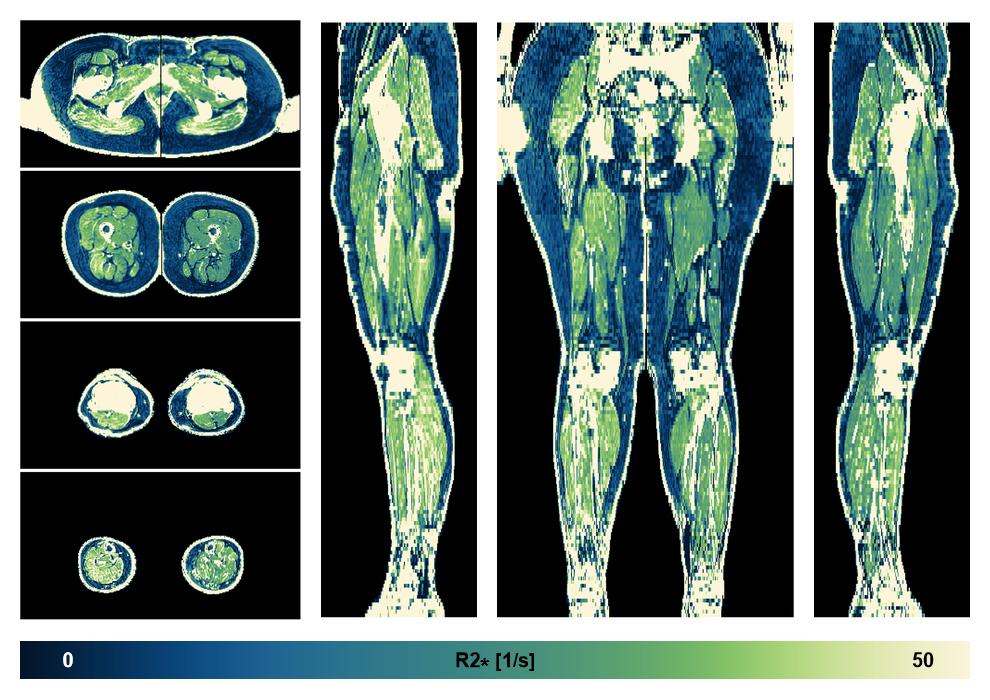 The R2 star relaxation time of the lower extremity obtained from the dixon reconstruction for muscle water fat quantification.