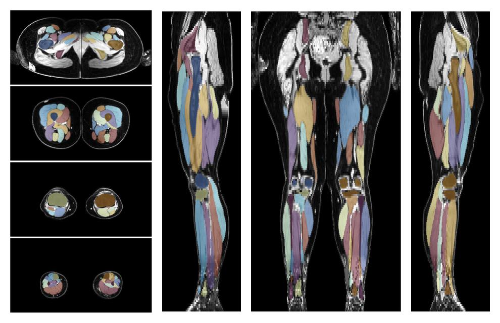 Overlay of automated muscle segmentation labels on dixon water image.