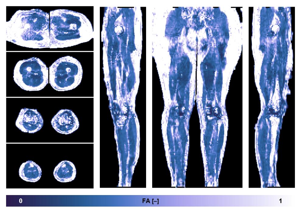 IVIM corrected whole leg muscle fractional anisotropy obtained from diffusion tensor imaging.