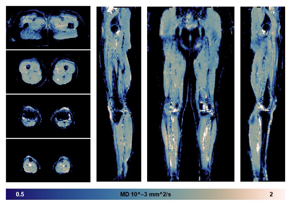 IVIM corrected whole leg muscle mean diffusivity obtained from diffusion tensor imaging.