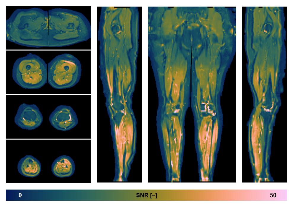 SNR distribution of the unweighted diffusion data.