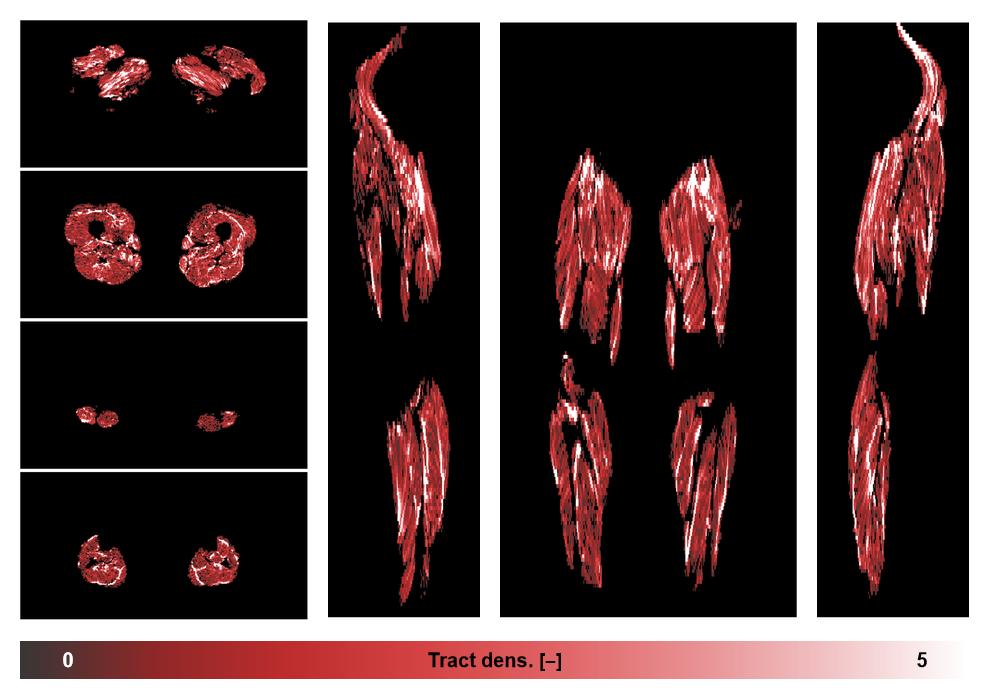 Muscle fiber tract density map based on whole leg DTI based fiber tractography.