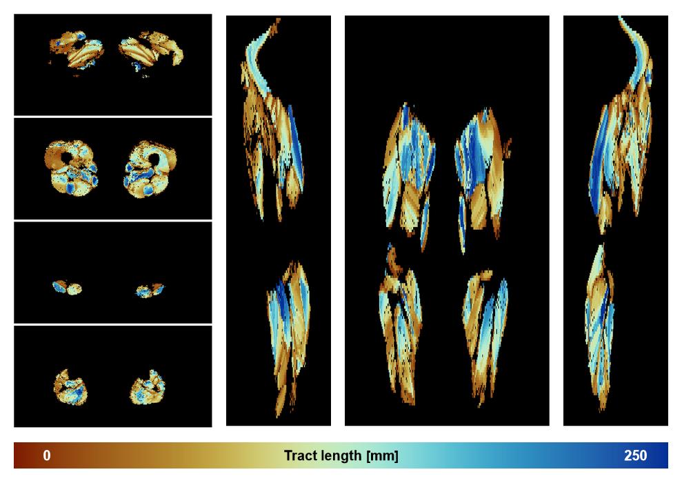 Muscle fiber tract length map based on whole leg DTI based fiber tractography.