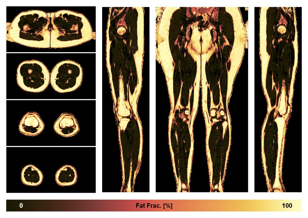 The fat fraction of the lower extremity obtained from the dixon reconstruction for muscle water fat quantification.