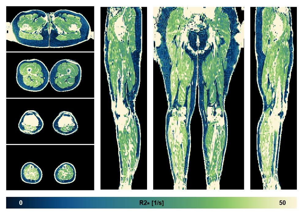 The R2 star relaxation time of the lower extremity obtained from the dixon reconstruction for muscle water fat quantification.